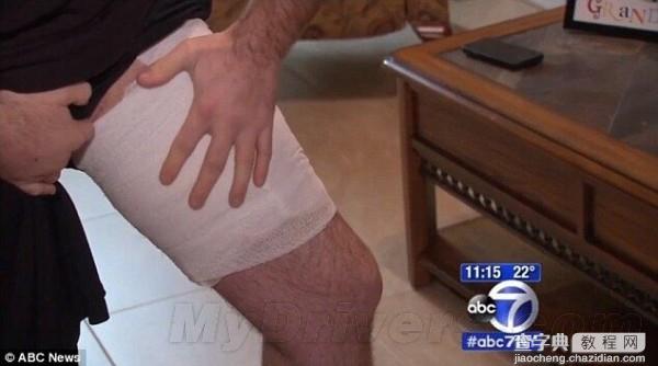 男子iPhone 5C口袋中爆炸 大腿处留一巨大伤疤1